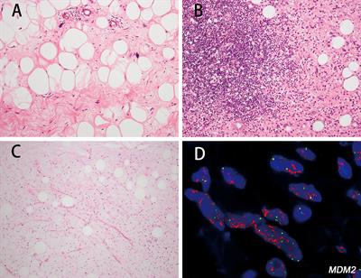 Primary intrathoracic liposarcomas: A clinicopathologic and molecular study of 43 cases in one of the largest medical centers of China